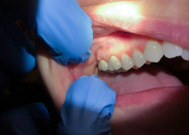 Emergency Dental Filling Replacement in KS